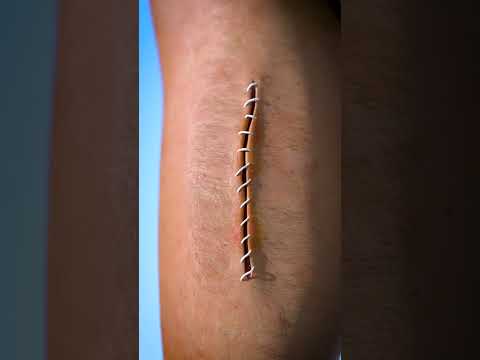 how stitches work f09f98af